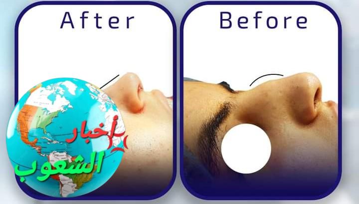الجديد في عمليات تجميل الأنف