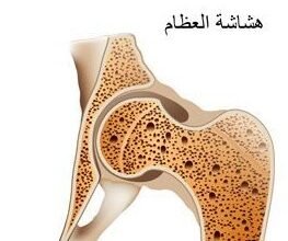 سويسرا.. تطوير مادة تعيد بناء العظام في وقت قياسي