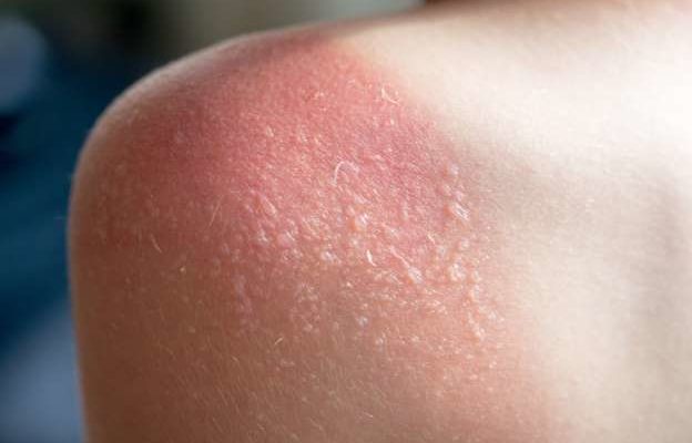 مرض تحلل البشرة السميّ مرض خطير ونادر